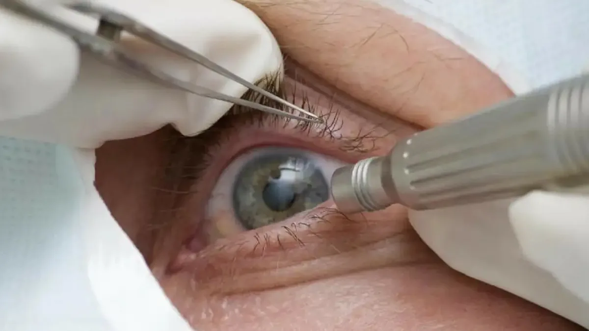 SUS incorpora cirurgia para tratar glaucoma e catarata em uma operação